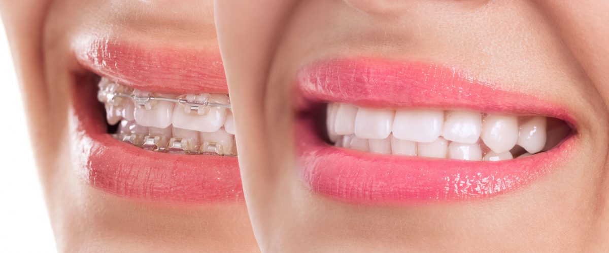 Beautiful teeth after braces treatment close up